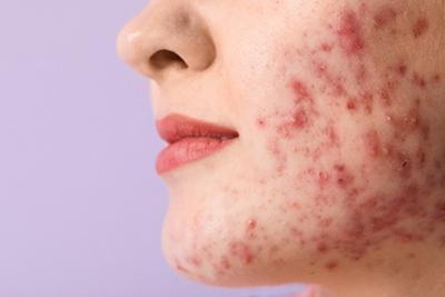 Clearer Skin Starts with Acne Treatment
