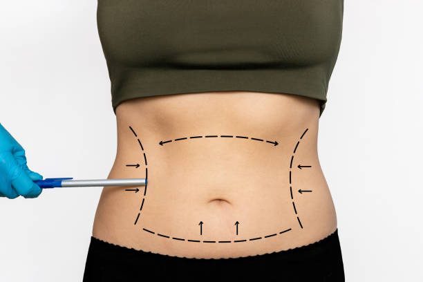 Create Balanced, Sculpted Curves with Liposuction