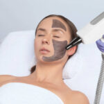 Does Laser Carbon Peel Remove Blackheads