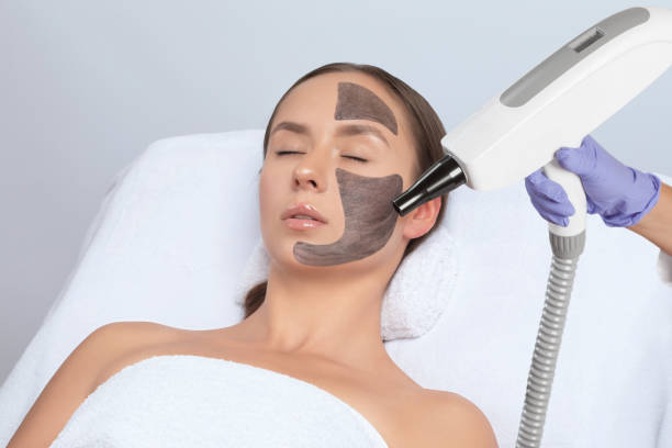 Does Laser Carbon Peel Remove Blackheads