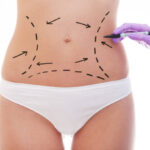 Does Lipo abdominoplasty Tighten Muscles