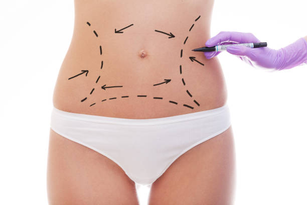 Does Lipo abdominoplasty Tighten Muscles