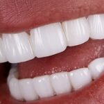 Dose E-Max Veneers Improve Bite Function Safely