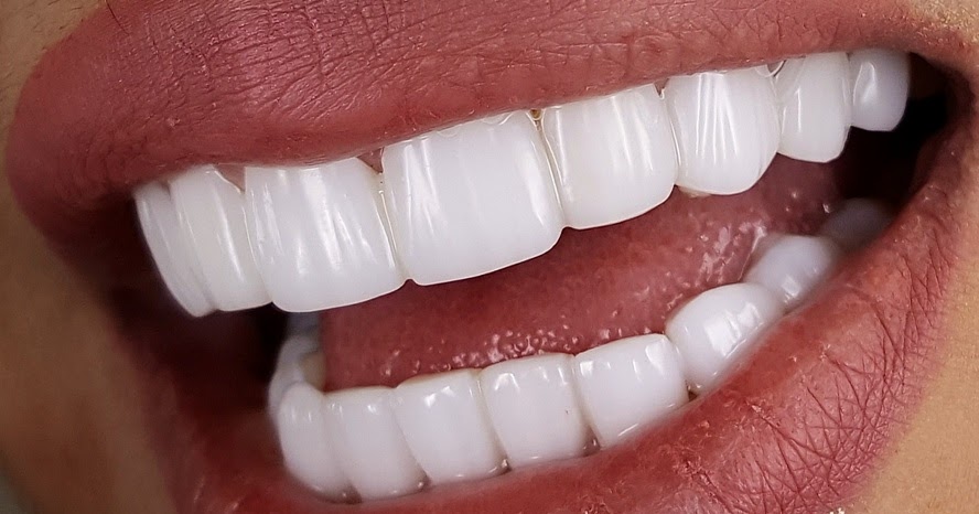 Dose E-Max Veneers Improve Bite Function Safely