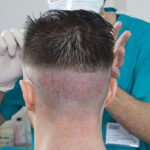 Hair Transplant Confidence That Grows Naturally