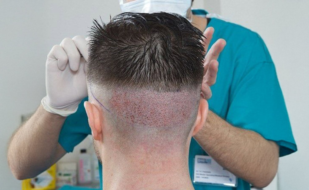 Hair Transplant Confidence That Grows Naturally