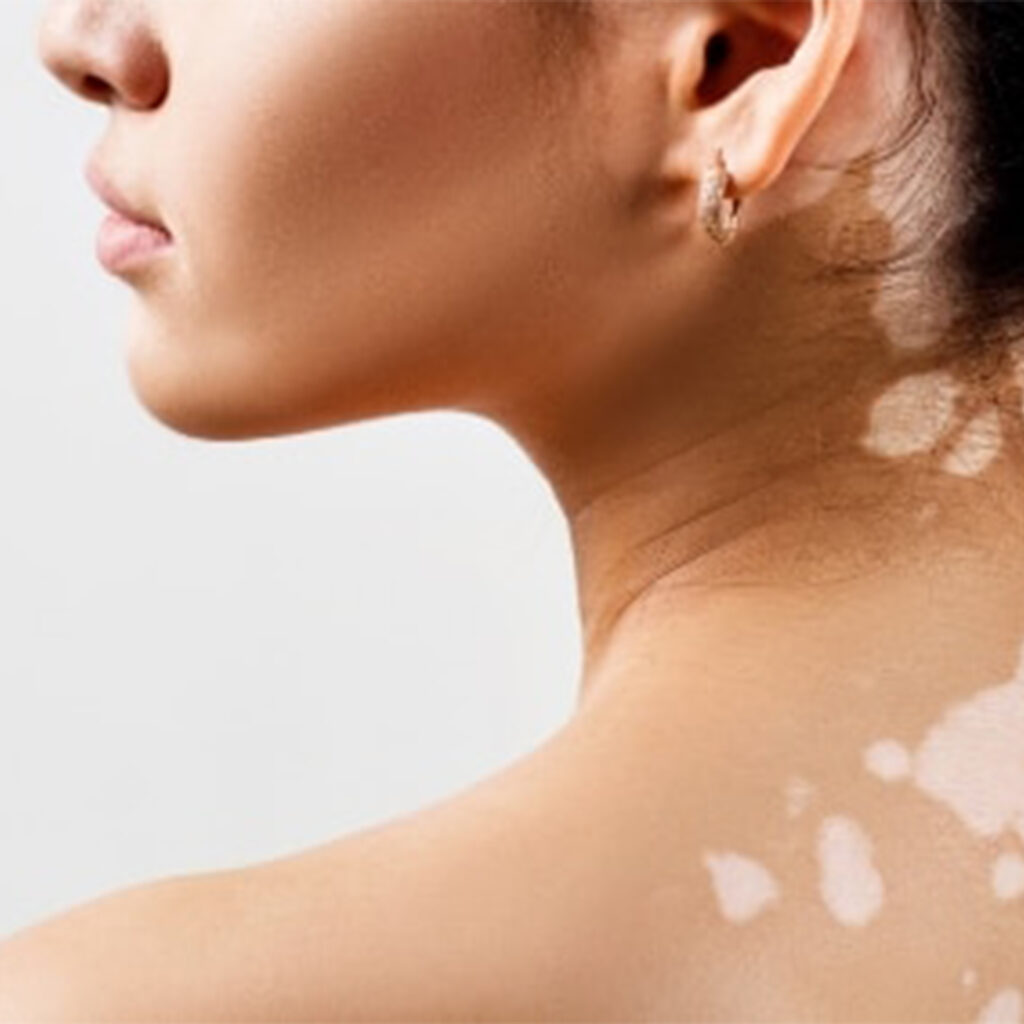 How Can Vitiligo Treatment Improve Skin Appearance Fast