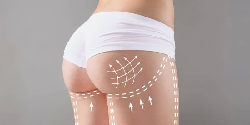 How Does Buttock Augmentation Enhance Body Contours