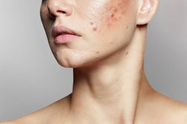 How Does Chemical Peel Acne Treatment Improve Skin