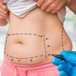 How Does Lipo Abdominoplasty Improve Your Waistline