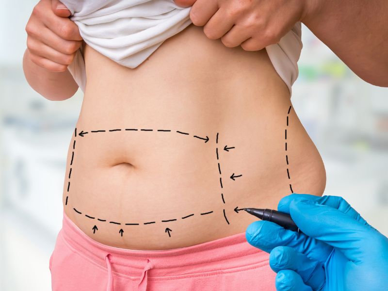 How Does Lipo Abdominoplasty Improve Your Waistline
