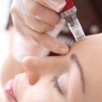 How Does Microneedling Improve Skin Texture Fast