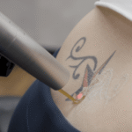 How Does Picosure Tattoo Removal Work Effectively