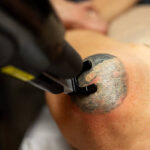 How Does Tattoo Removal Work on Old Ink