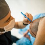 How Effective Is FUE Hair Transplant for Hair Loss