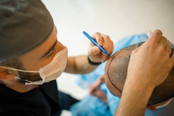 How Effective Is FUE Hair Transplant for Hair Loss