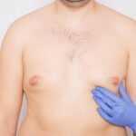 How Effective Is Gynecomastia Surgery for Men