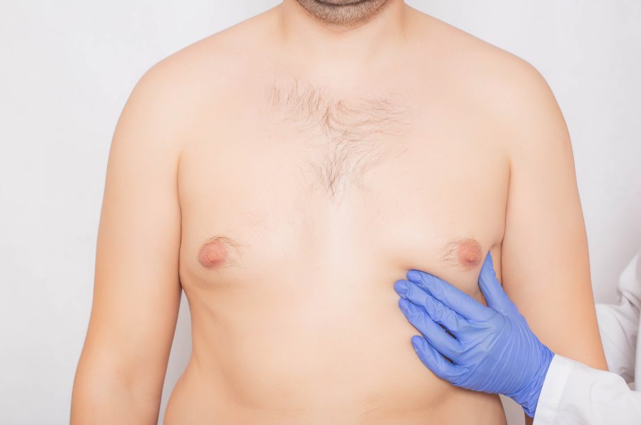 How Effective Is Gynecomastia Surgery for Men
