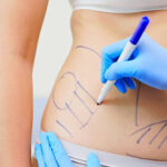 How Safe Is Liposuction for Long Term Results