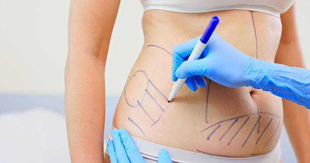 How Safe Is Liposuction for Long Term Results