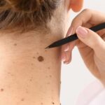 How Safe Is Mole Removal for Facial Skin