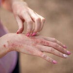 Is Eczema Treatment Long-Lasting