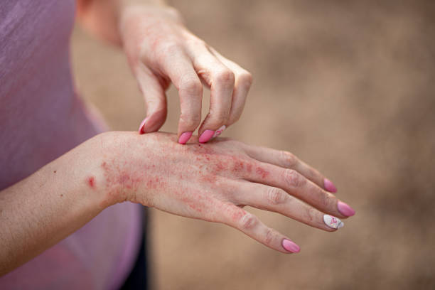 Is Eczema Treatment Long-Lasting