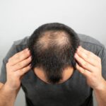 Is GFC Treatment for Hair Worth It for Hair Loss