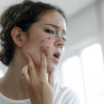 Is Laser Acne Scar treatment safe for all skin tones