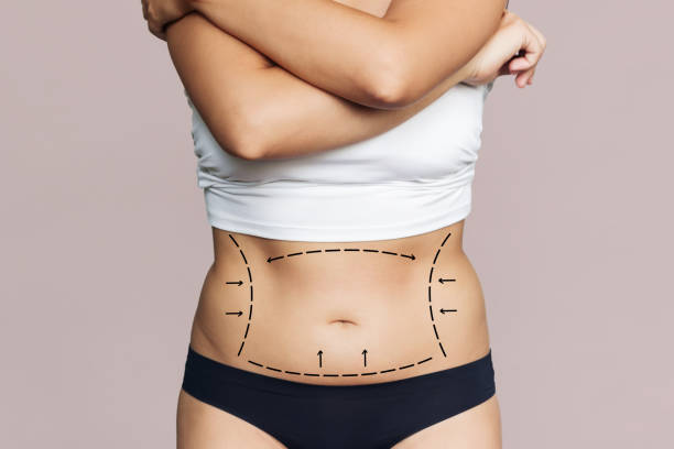 Is Liposuction Permanent Fat Removal