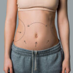 Is Liposuction Suitable for Mild to Moderate Fat