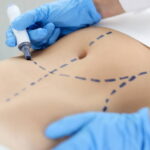 Is Liposuction Surgery Safe for Weight Reduction
