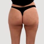 Modern Non‑surgical Bum Lift Treatments for Today’s Lifestyle