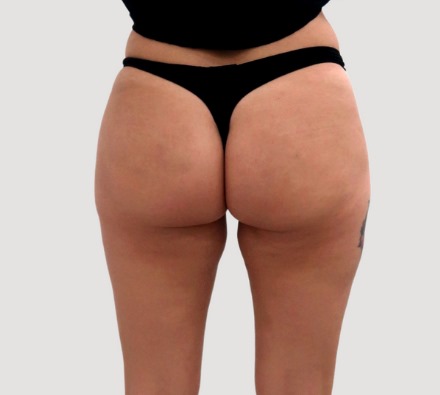 Modern Non‑surgical Bum Lift Treatments for Today’s Lifestyle