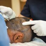 Natural Hairline Design with FUE Hair Transplant