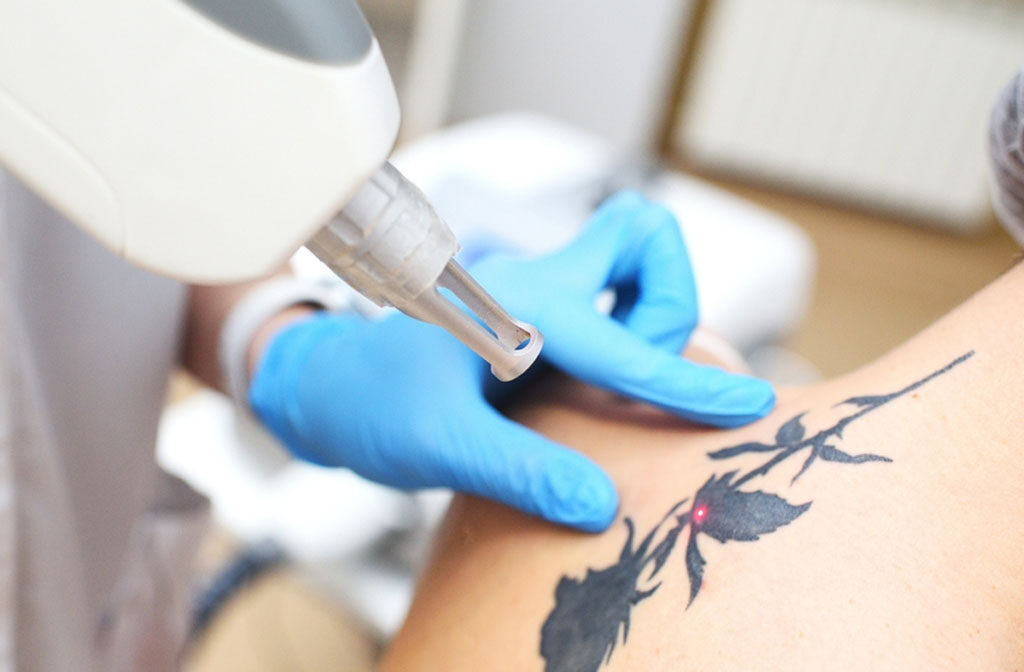 Non-Surgical Laser Tattoo Removal