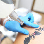Non-Surgical Laser Tattoo Removal