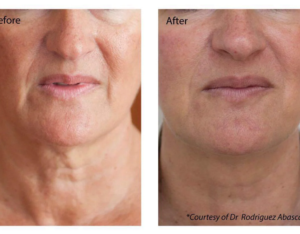 Profhilo at The Medispa: Advanced Skin Booster for Natural, Youthful Radiance