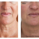 Profhilo at The Medispa: Advanced Skin Booster for Natural, Youthful Radiance