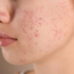 What Is the Best Acne Treatment for Teens