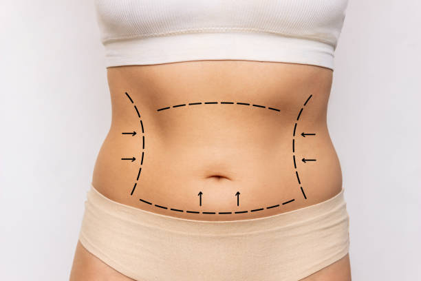 What Makes Liposuction So Popular