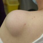 What Options Exist for Lipoma Treatment Today