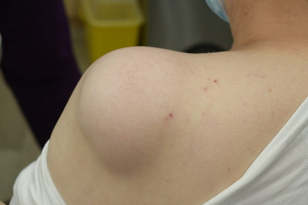 What Options Exist for Lipoma Treatment Today