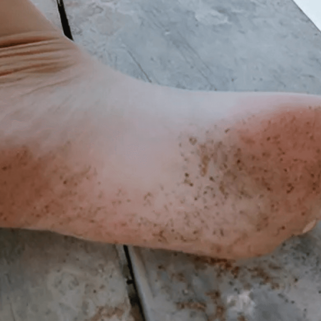 Black-Patches-on-Bottom-of-Feet: Home Remedies