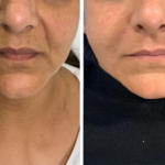 Dermal Fillers at The Medispa: Restore Volume, Define Contours, Enhance Natural Beauty