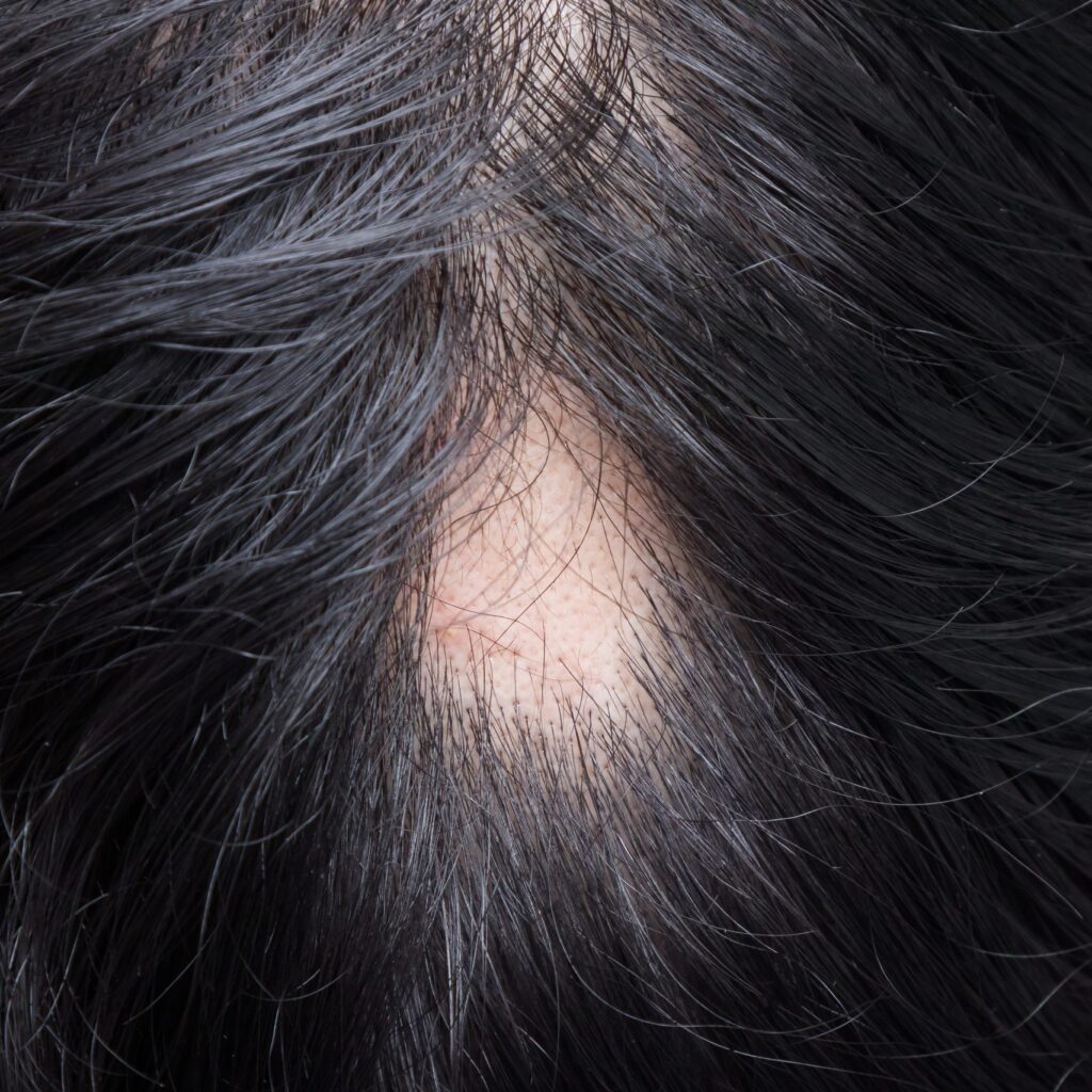 ما هي الخيارات العلاجية الجديدة لداء الثعلبة؟