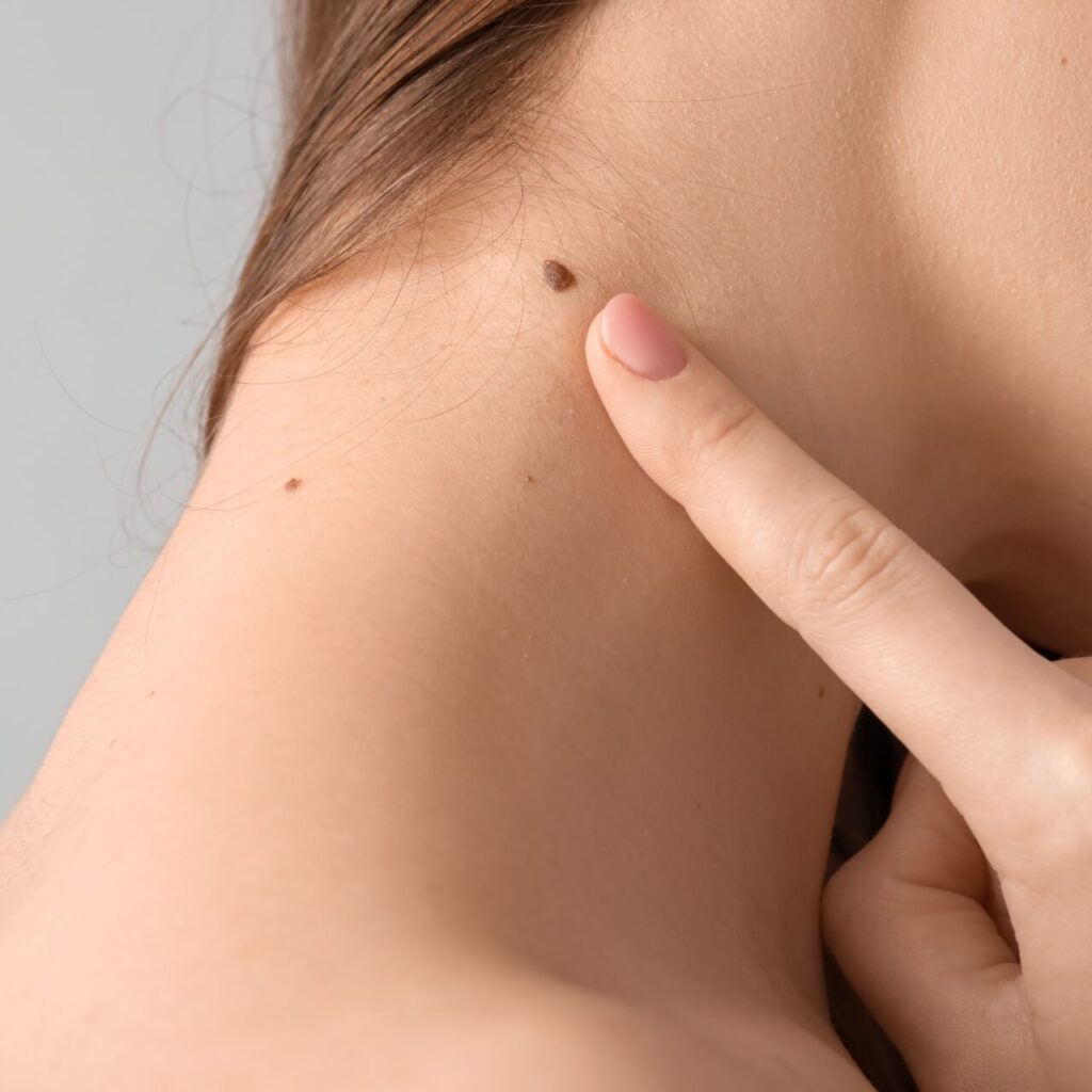 هل تتطلب إزالة الشامات جلسات متعددة؟