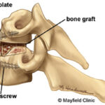 Risks and Benefits of Anterior Cervical Fusion Surgery Explained