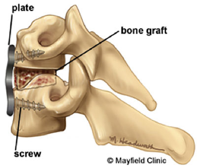 Risks and Benefits of Anterior Cervical Fusion Surgery Explained